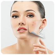 Herbal Acne Pills, Remove Pimples